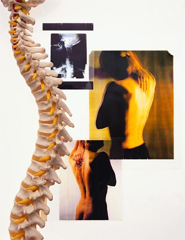 Extension Related Back Pain